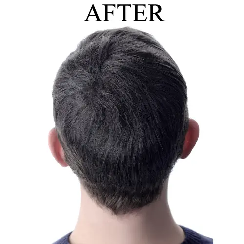 Hair Replacement After