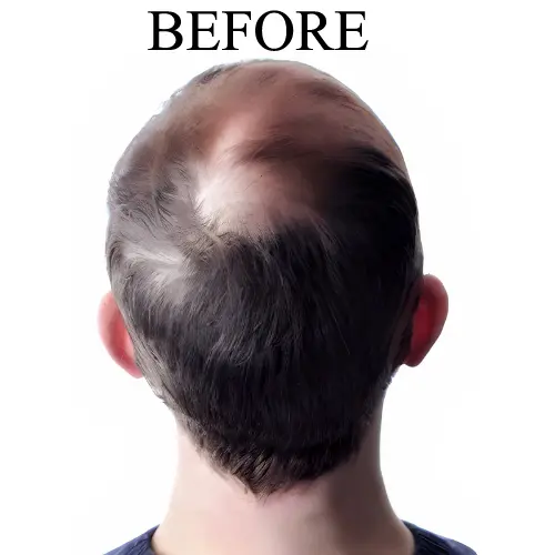 Hair Replacement Before