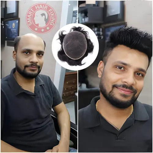 What Is Hair Fixing for Men