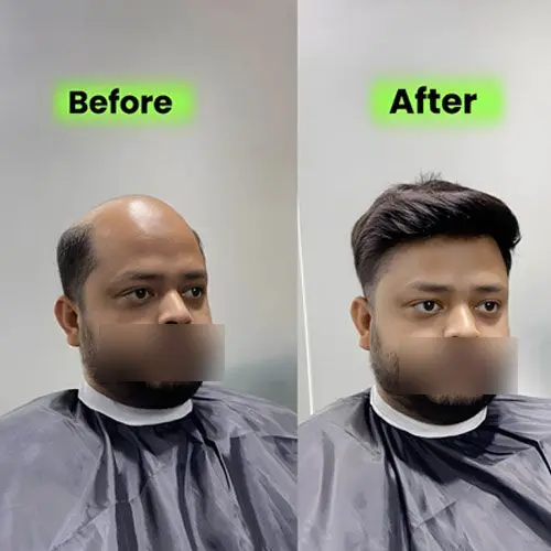 What Is Non-Surgical Hair Replacement for Men