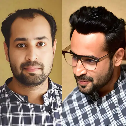 Hair Bonding for Men in UAE