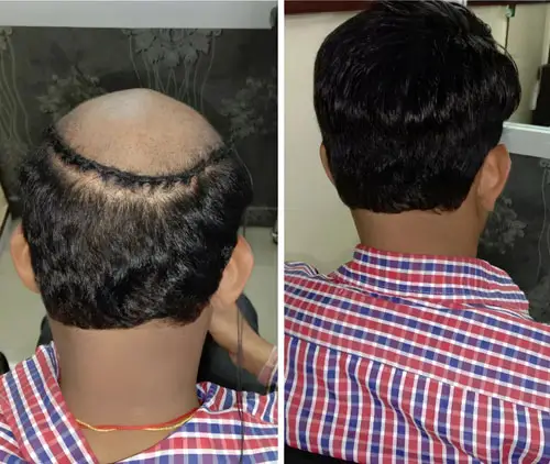 Hair Weaving Service in Dubai by Smart Hair Fixing