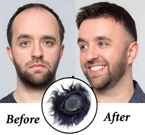Non-Surgical Hair Replacement Dubai by Smart Hair Fixing
