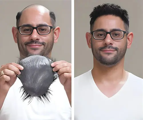 Wigs for Cancer Patients in UAE