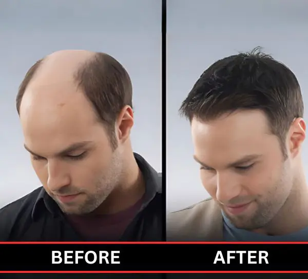 Hair Patch Service by Smart Hair Fixing