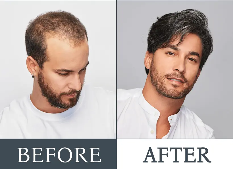 Hair System Service with Smart Hair Fixing