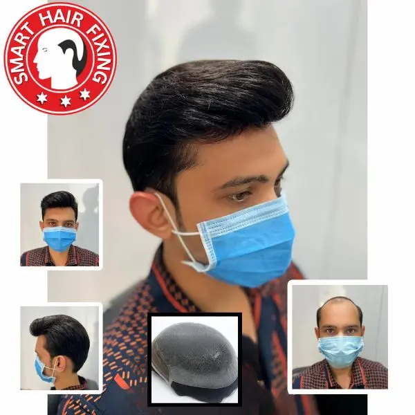 Non-Surgical Hair Replacement Service by Smart Hair Fixing