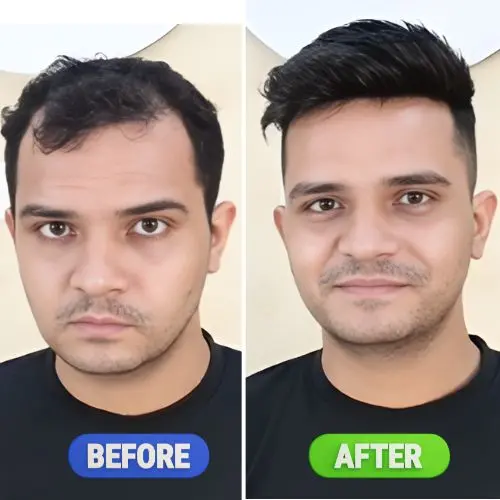 Hair Fixing in Sharjah by Smart Hair Fixing