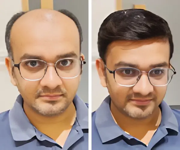 Hair Fixing in UAE by Smart Hair Fixing